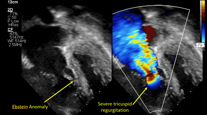 Ebstein's Anomaly, pre-surgery, showing severe tricuspid regurgitation