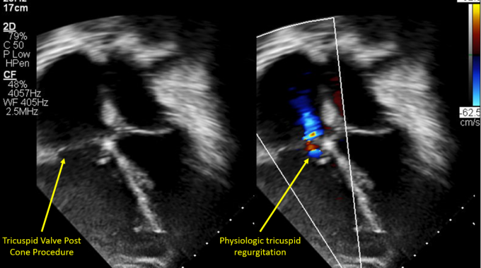 Repaired tricuspid valve, post-cone procedure.