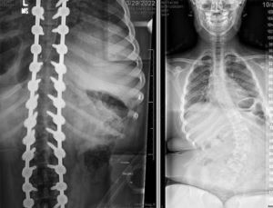 Spinal x-rays