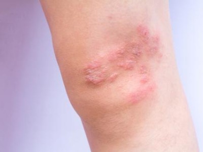 Psoriasis on patient's knee