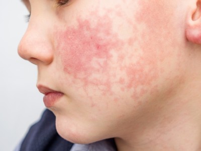 Closeup of rash on child's face