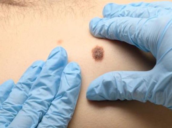 Masked hands near a mole