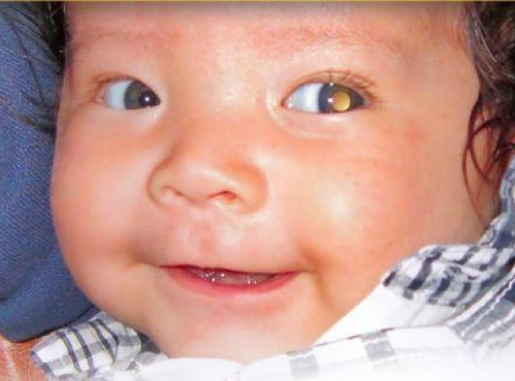 Baby with a glow in their eye