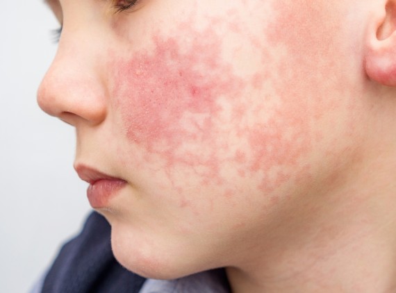 Closeup of rash on child's face